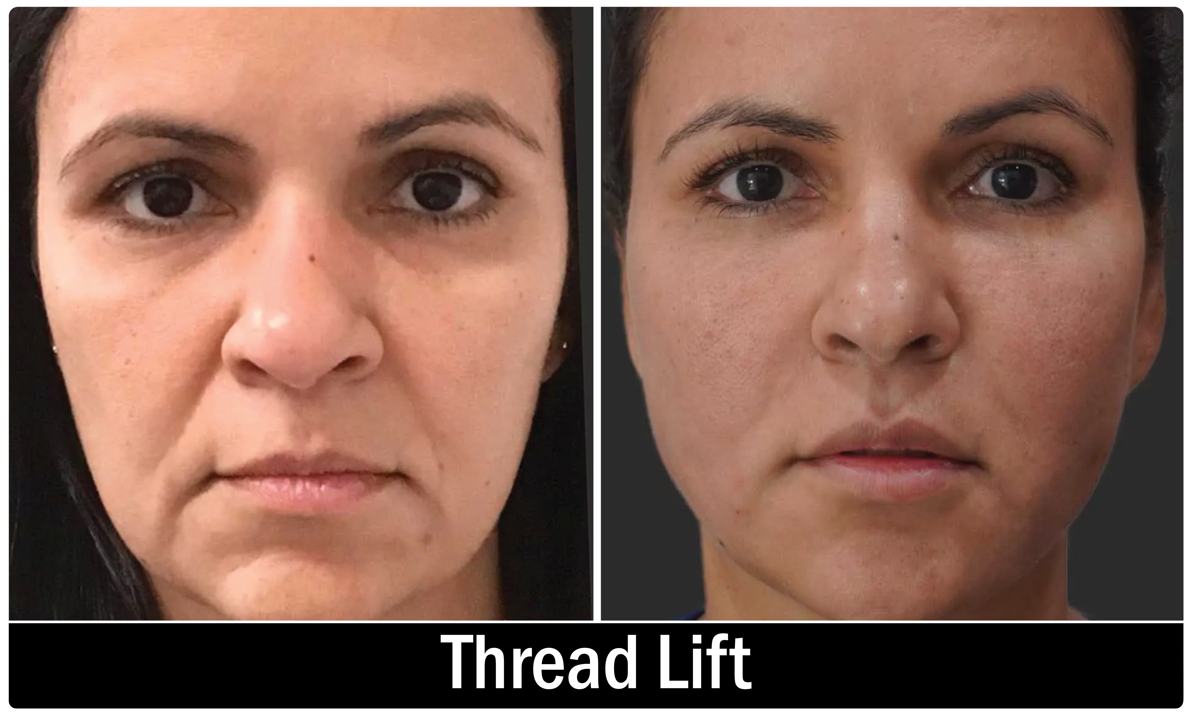 Upper Eyelid Thread Lift KOQ10